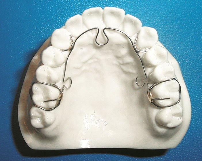 Maloclusion